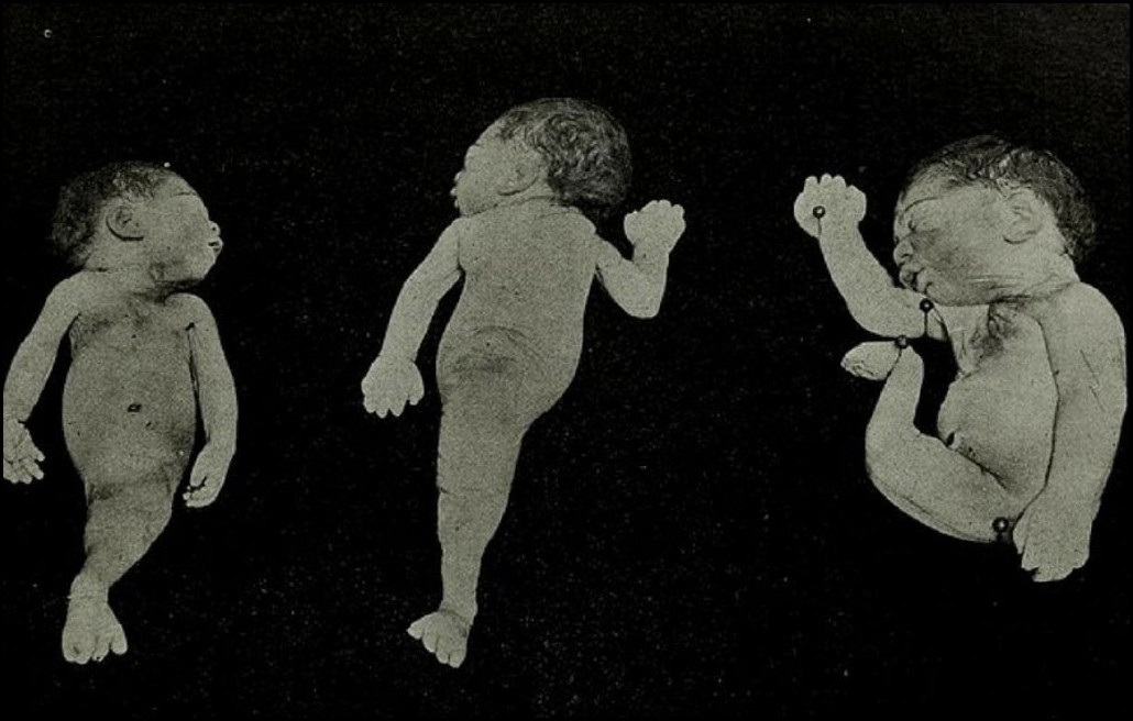 Mermaid Syndrome or Sirenomelia Symptoms and treatment mermaid syndrome